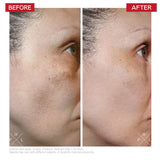 Radical3 Reboot Pro Peel before & after results – smoother skin