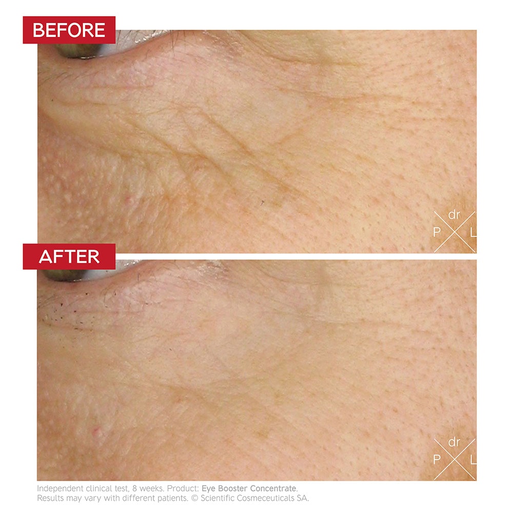 Before & after Dr. LEVY Eye Booster Concentrate – reduced puffiness & fine lines